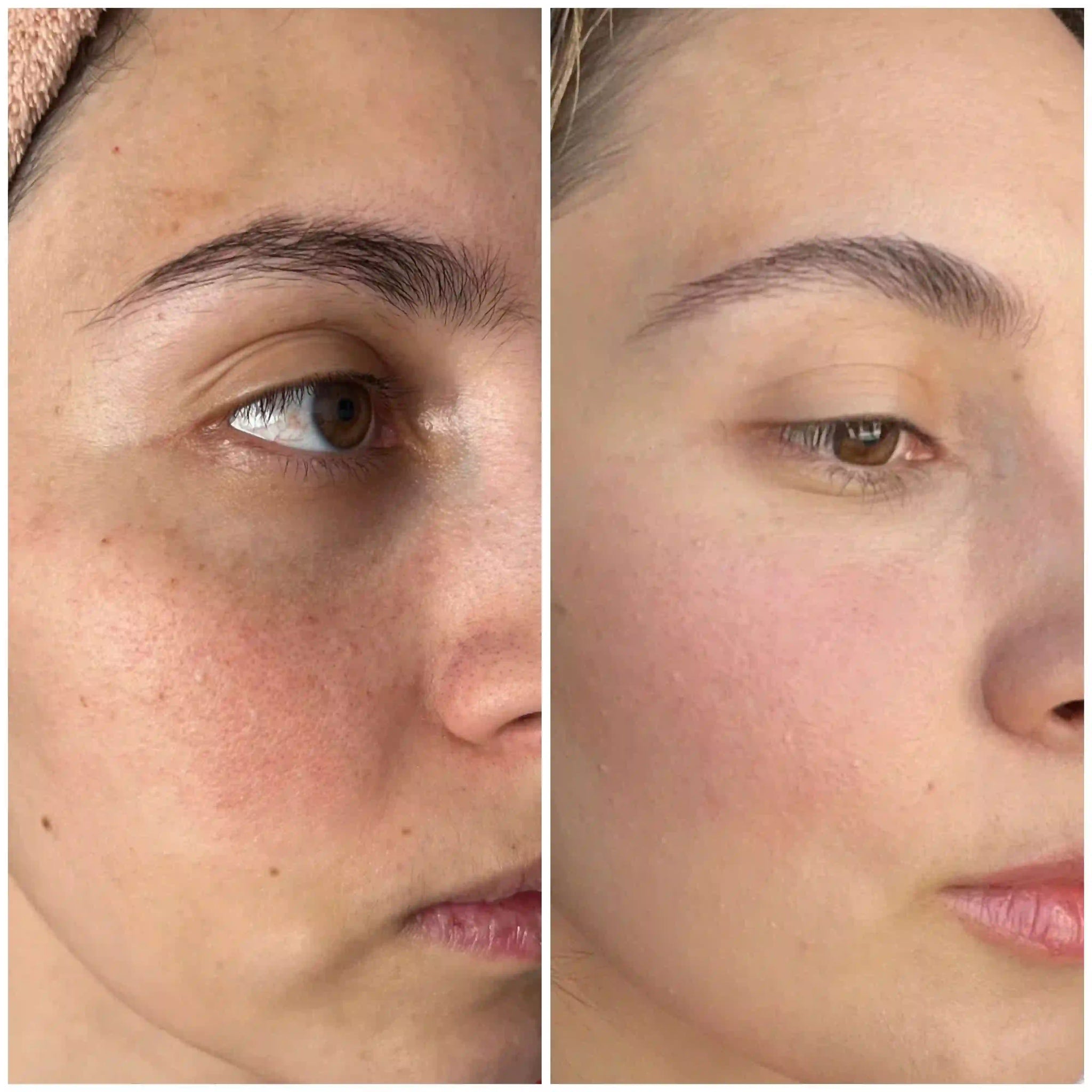 Before and after results of a woman after treatment