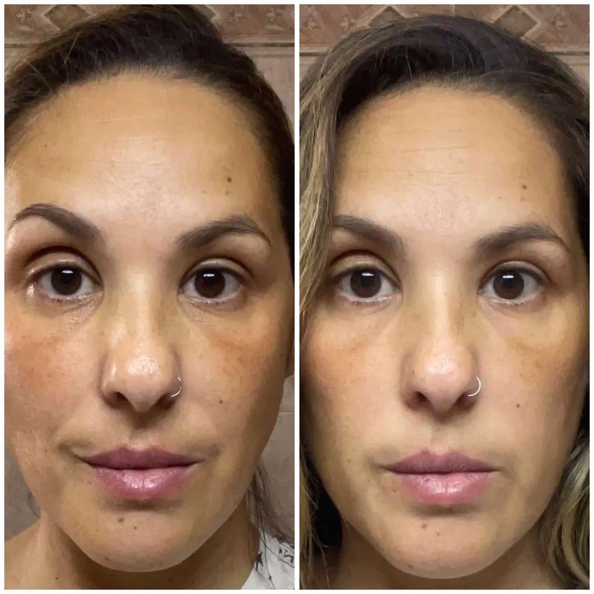 Before and after results of a woman after treatment