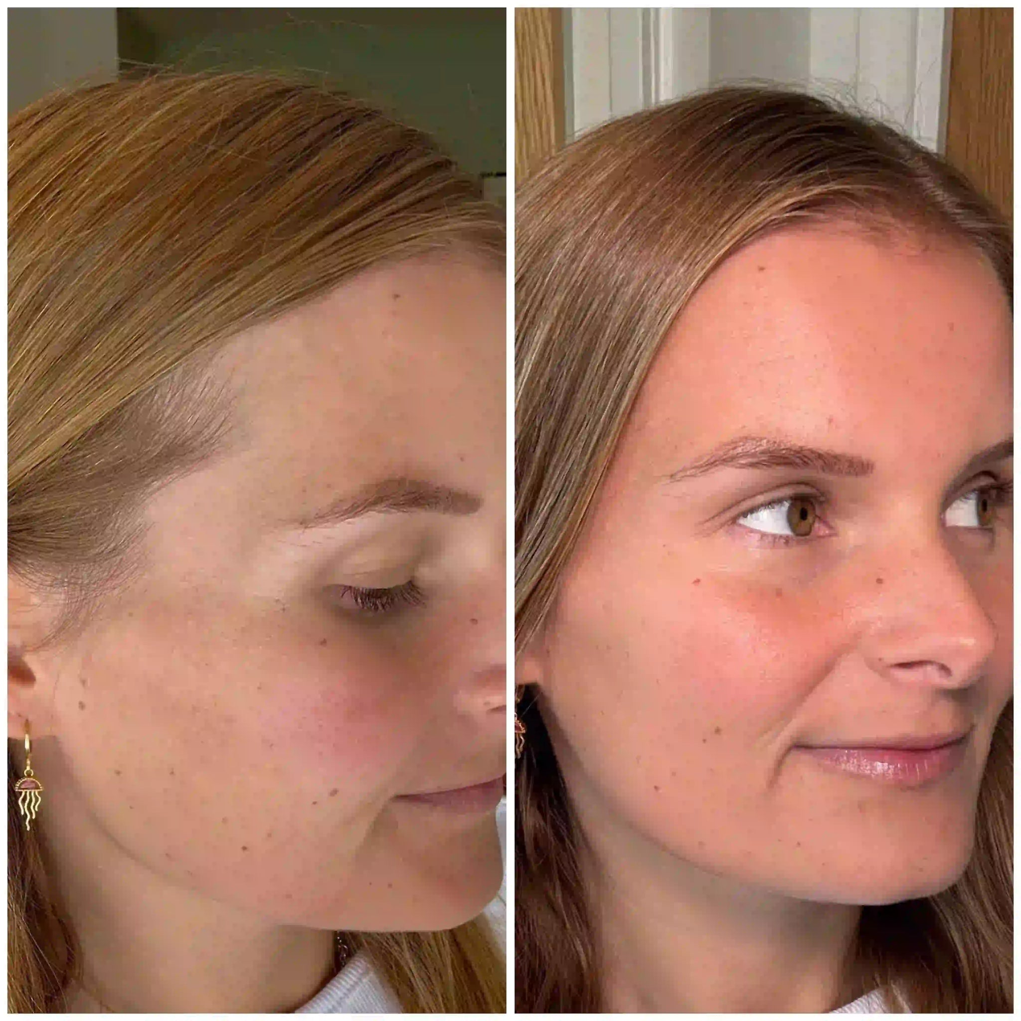 Before and after results of a woman after treatment